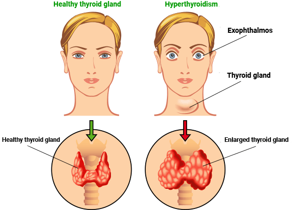 Thyrolin